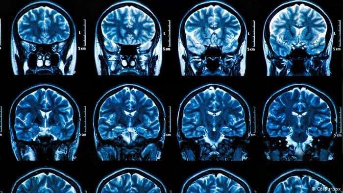 Avances Innovadores en el Pronóstico de la Esclerosis Múltiple: Herramienta Basada en Inteligencia Artificial