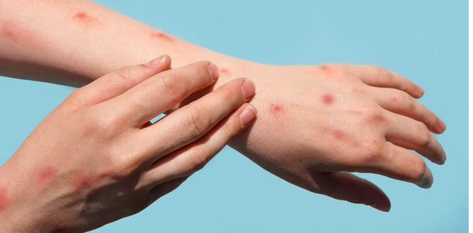 África sufre 622 muertes por mpox y aguarda vacunas