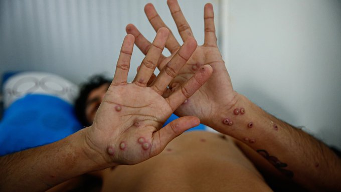 OMS declara nuevamente al mpox como emergencia global
