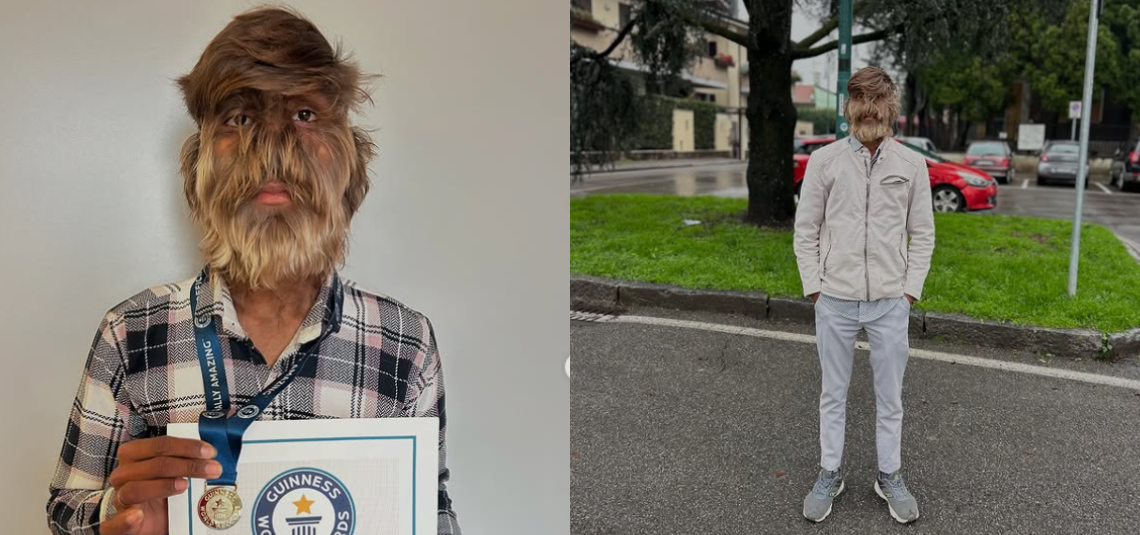 Joven con rara condición gana Récord Guinness por el rostro “más peludo”