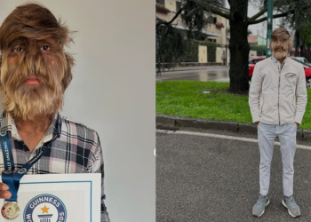 Joven con rara condición gana Récord Guinness por el rostro “más peludo”
